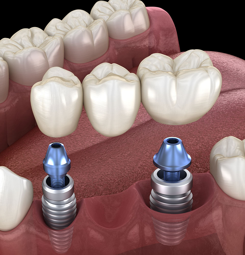 dental bridge 3d