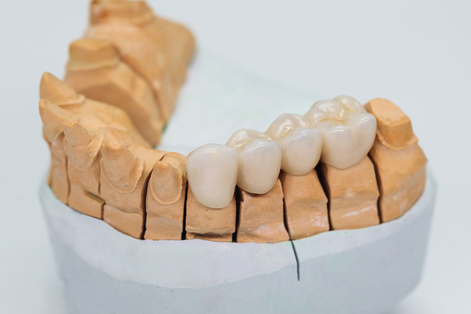 dental bridge real