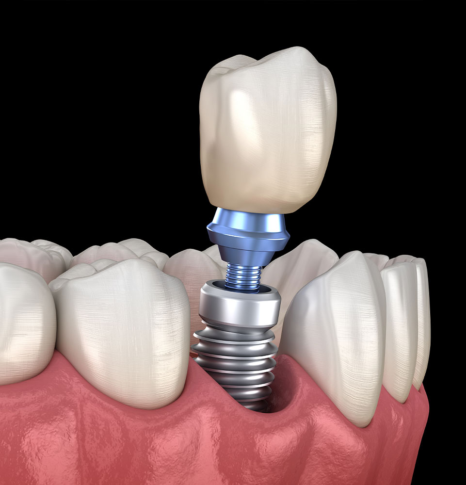 dental implant