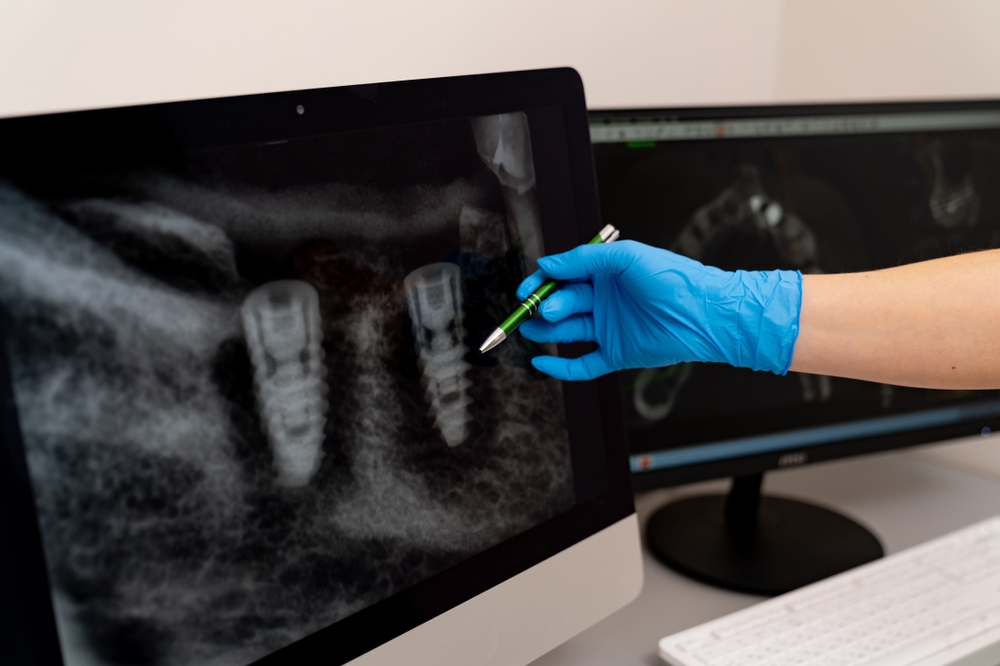 Dentist consulting patient about tooth extraction options in a modern dental office